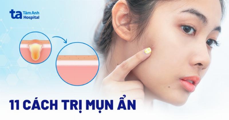  Chế độ sinh hoạt và dinh dưỡng hỗ trợ phục hồi da sau nặn mụn 